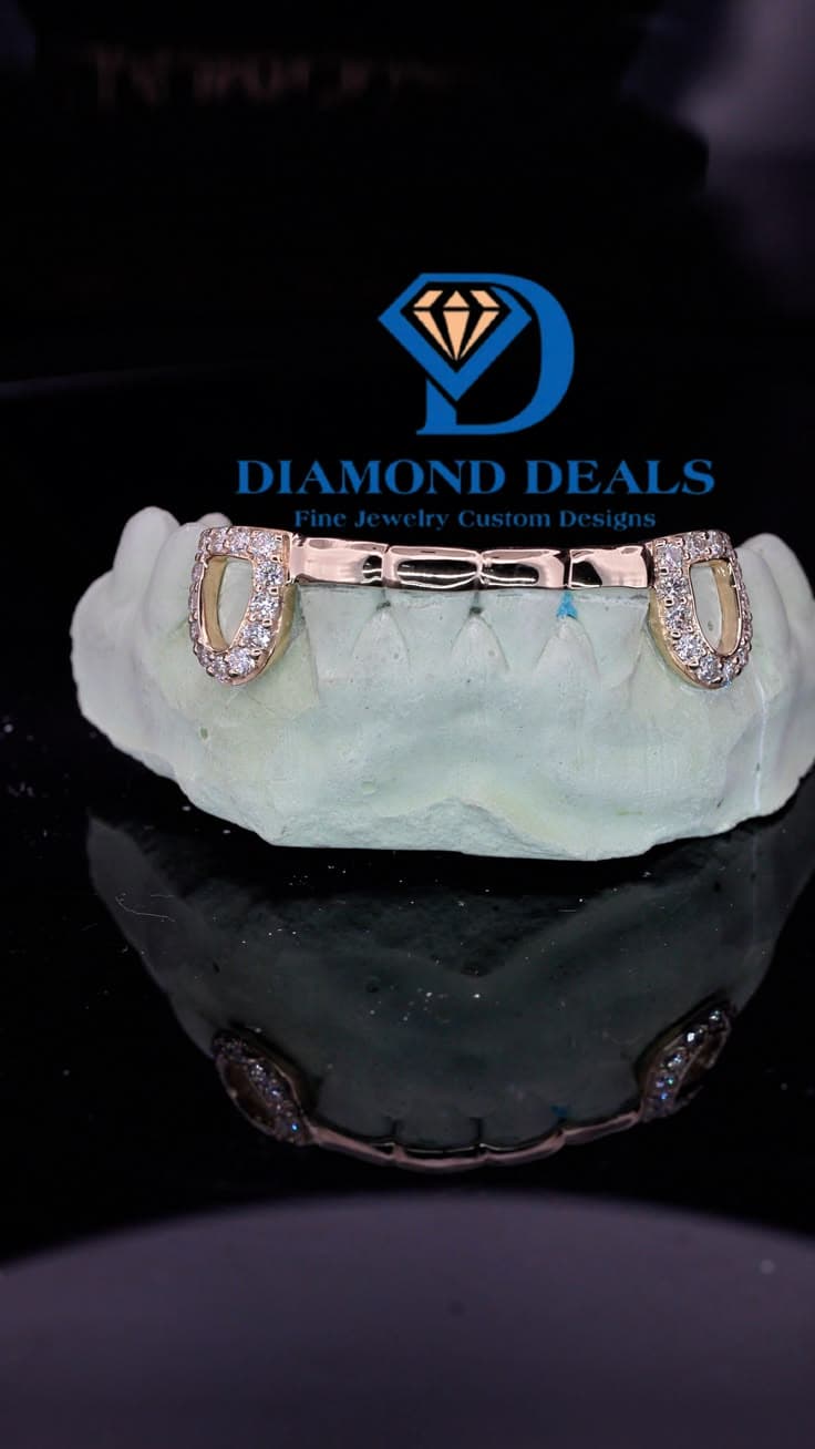 Custom Open-Face Grillz with Solid Bar